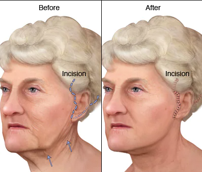 What You Should Know Before You Consider Facelift Surgery